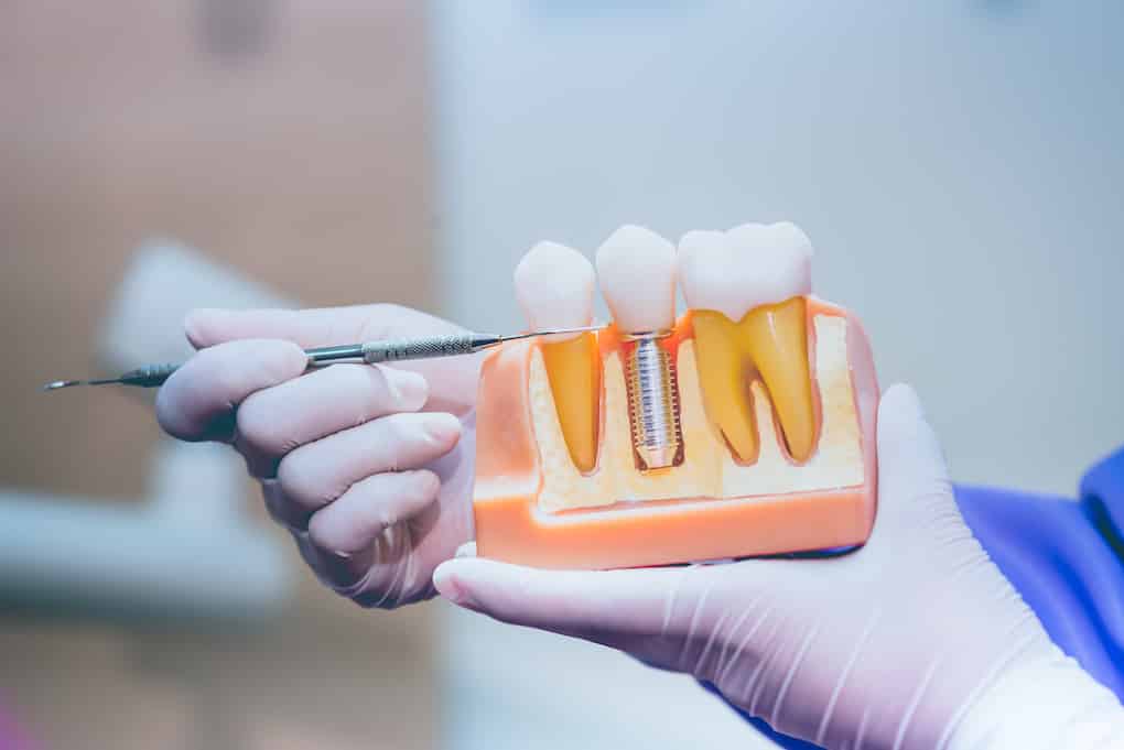 7 Crucial Facts About Dental Implant Surgery Every Patient Should Understand